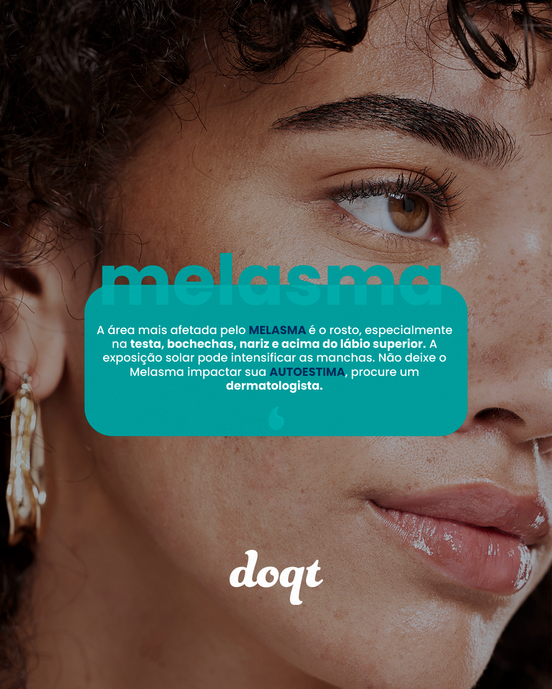 Melasma: Causas, Tratamentos e Como Prevenir as Manchas na Pele