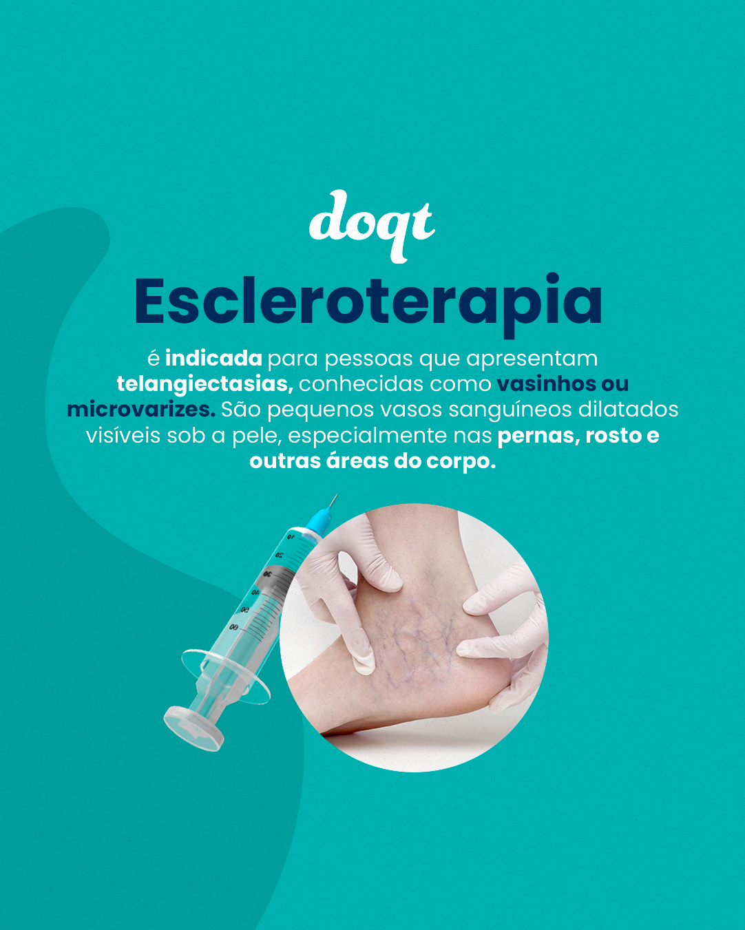 Escleroterapia: Tratamento Eficaz para Vasinhos e Microvarizes