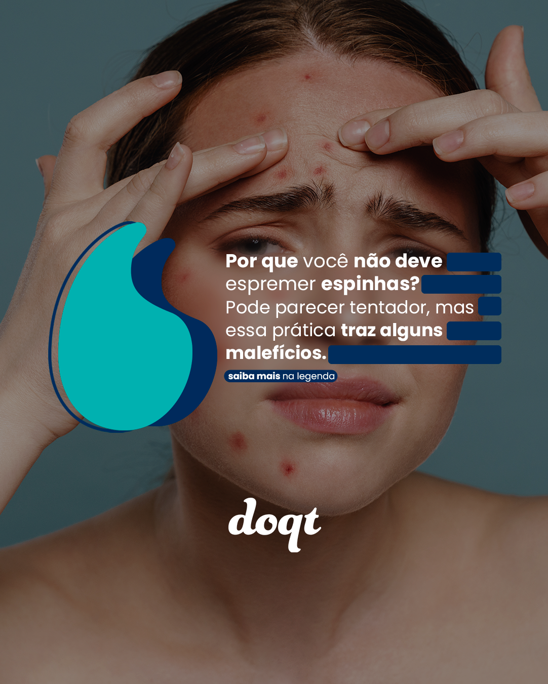Por Que Não Se Deve Espremer Espinhas? Entenda os Riscos e Saiba Como Tratar Corretamente